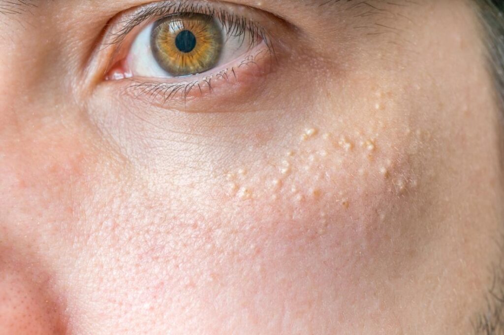 Skin Health and White Spots